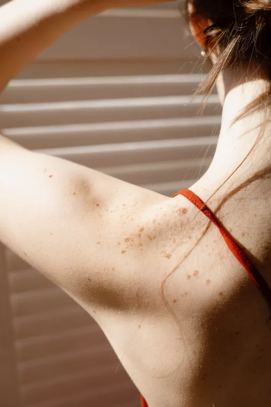 Close-up of freckled back and shoulder in sunlight, highlighting skin texture.